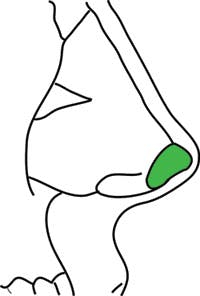 Caudal Extension Graft