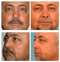 Rib Rhinoplasty