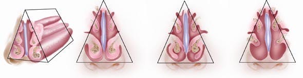 Nasal Obstruction: Turbinates