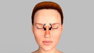 Septal Perforation Fold