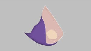 Septal Perforation No Vascular