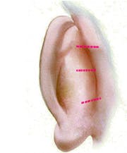 Mustarde Suture