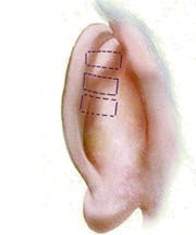 Conchal Bowl Resection and Setback