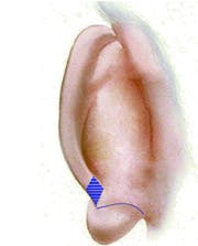 Caudal Helix and Lobule Prominence