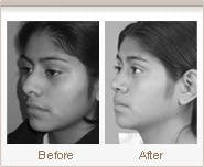 Crooked Nose Deformity before after Chicago
