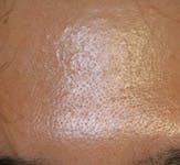 Botox Before