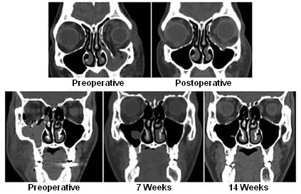 Preoperative and postoperative computed tomography scans