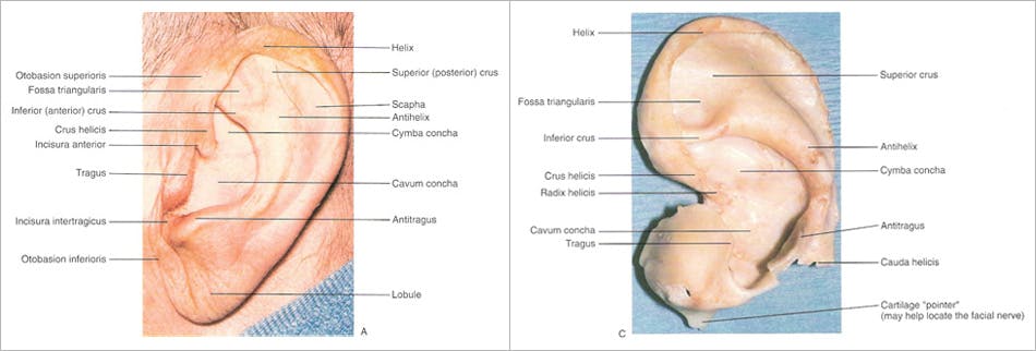 Otoplasty - Figure 1