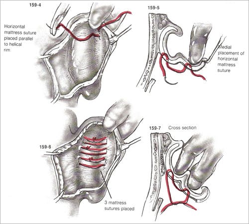 Otoplasty - Figure 2