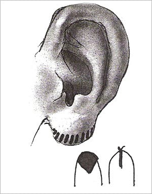 Otoplasty - Figure 4