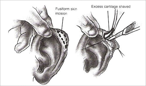 Otoplasty - Figure 5