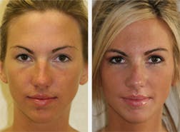 Rhinoplasty Photos