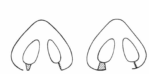 Alar Base Resection - Figure 8
