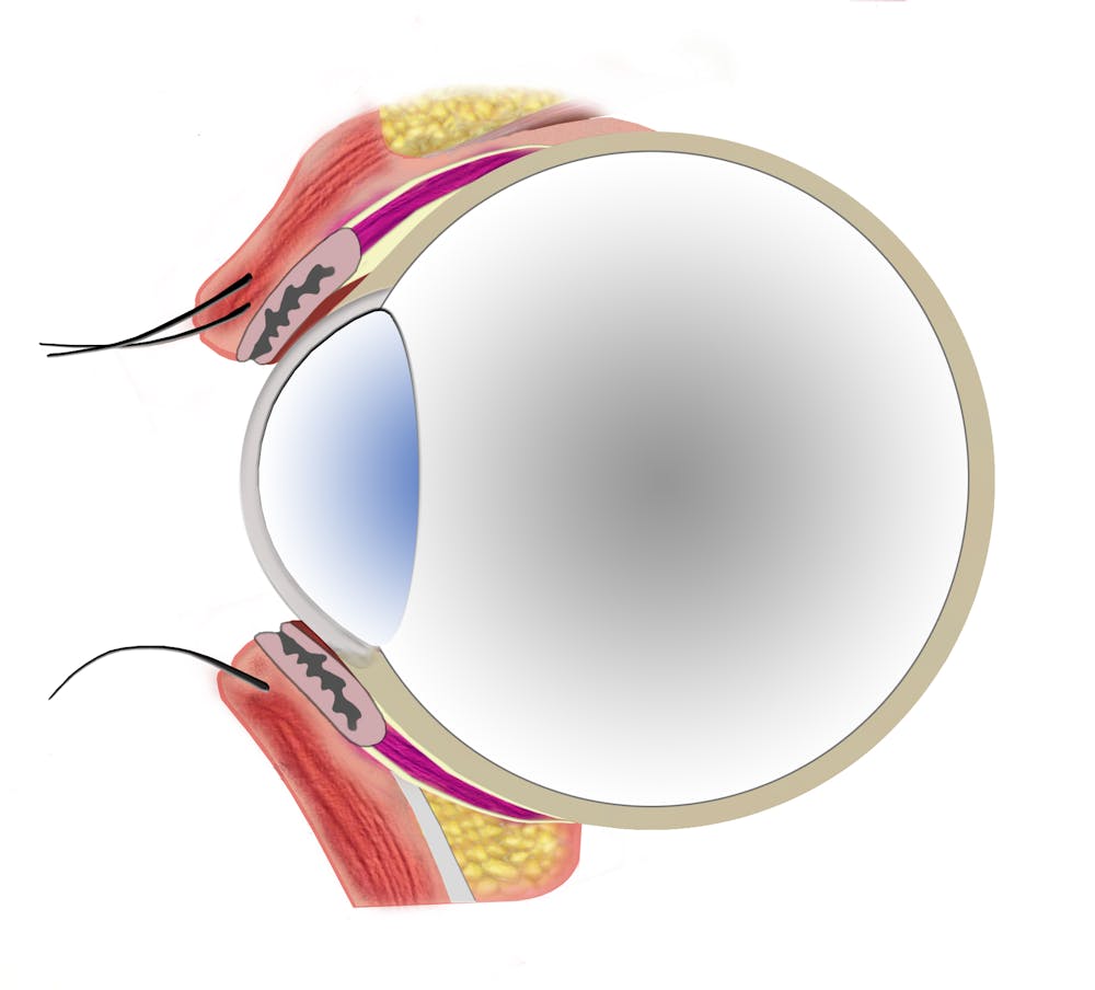 lowerlid profile preop