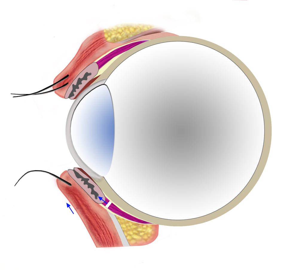 lowerlid profile postop