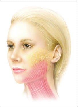 Artist’s depiction of the clinical superior extent of the platysma muscle