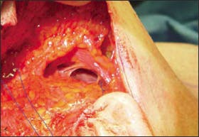 Intraoperative photograph