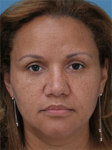 Nasal Reconstruction - Figure 1B