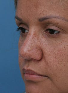 Nasal Reconstruction - Figure 1D