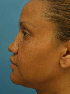 Nasal Reconstruction - Figure 1E