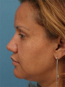 Nasal Reconstruction - Figure 1F