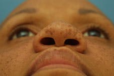 Nasal Reconstruction - Figure 1G