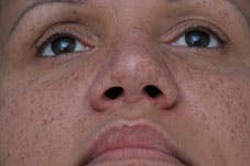 Nasal Reconstruction - Figure 1H