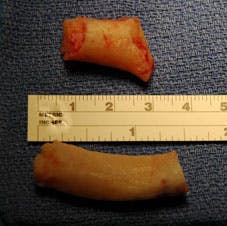 Nasal Reconstruction - Figure 2A