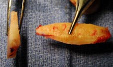 Nasal Reconstruction - Figure 2B