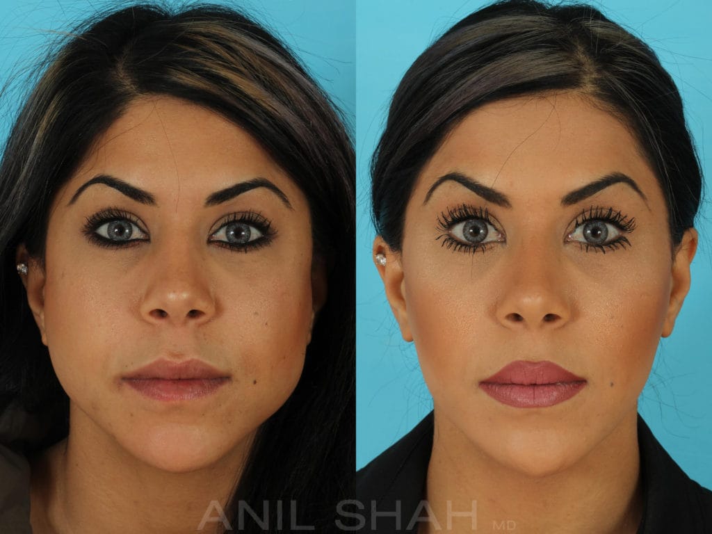 Masseter Reduction patient