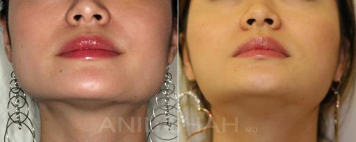 Masseter Reduction patient