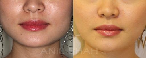 Masseter Reduction patient