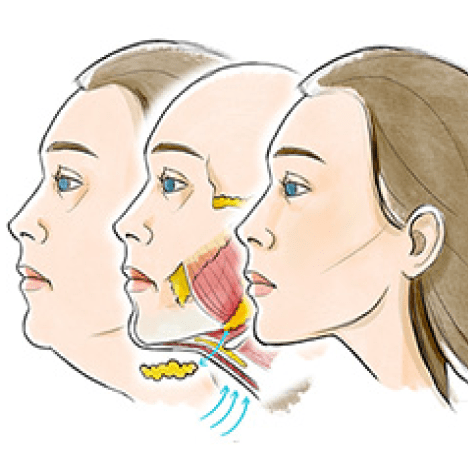 5 Layer Neck Lift media
