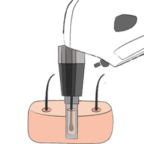 Hair Transplant media