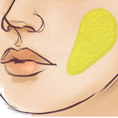 Buccal Fat Removal media