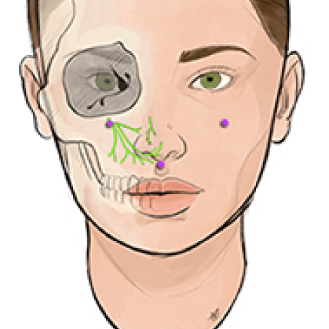 Pain Free Rhinoplasty media