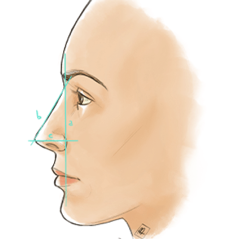 Types of Rhinoplasty media