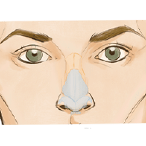 Open Vs Closed Rhinoplasty media