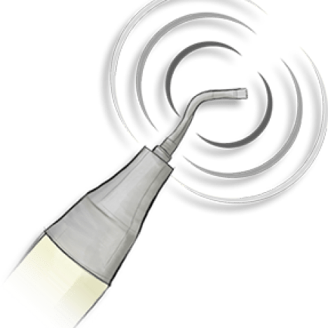 Ultrasonic Rhinoplasty media