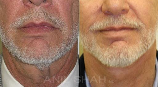Before & Afters Before & After Gallery - Patient 642221 - Image 1