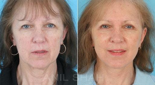 Before & Afters Before & After Gallery - Patient 414571 - Image 1