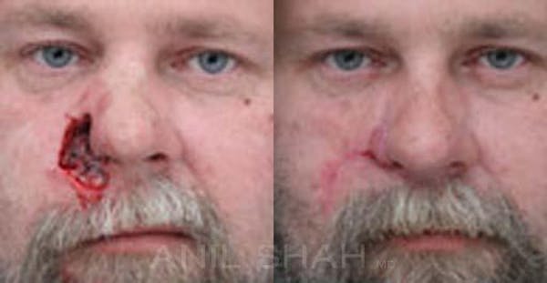 Facial Reconstruction Before & After Gallery - Patient 150097 - Image 1