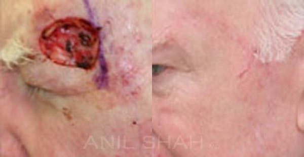 Facial Reconstruction Before & After Gallery - Patient 709660 - Image 1
