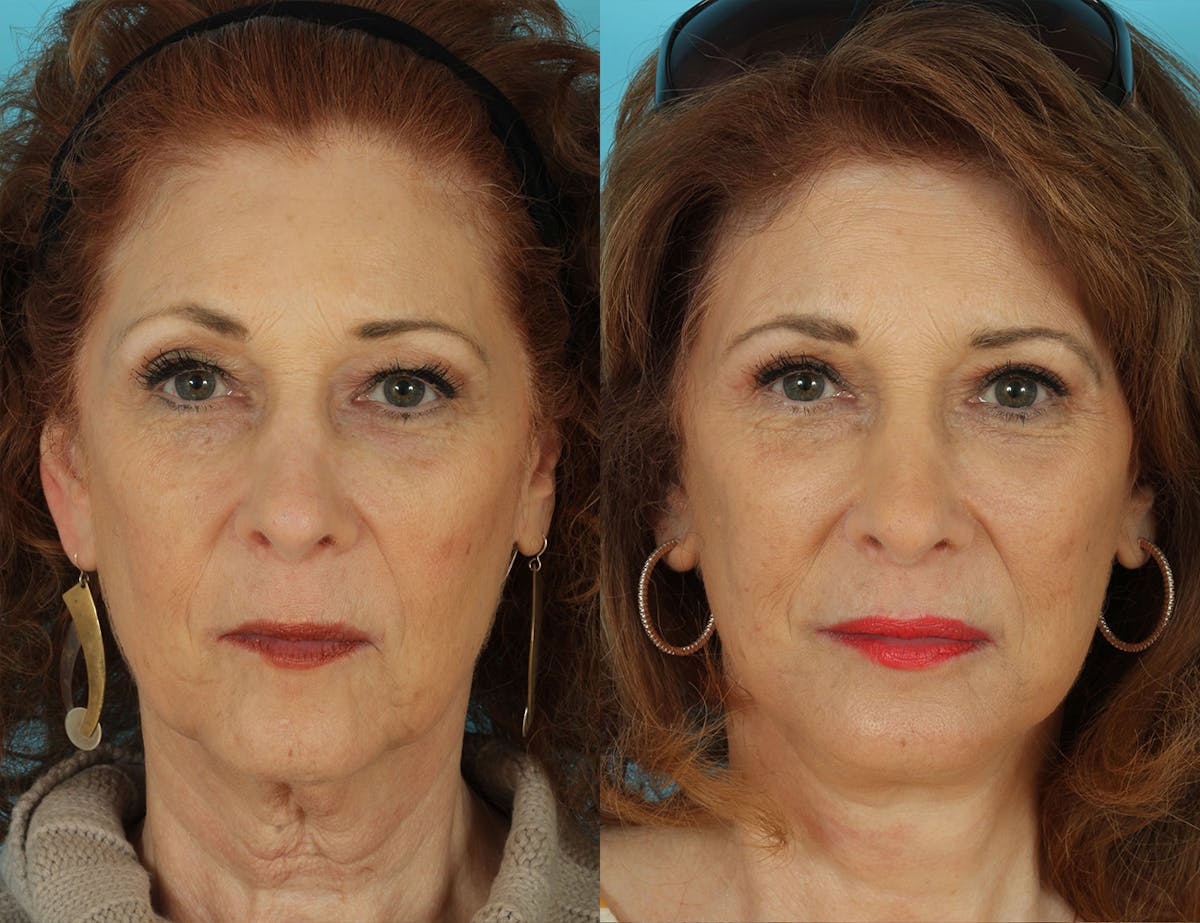 Before & Afters Before & After Gallery - Patient 406568 - Image 1
