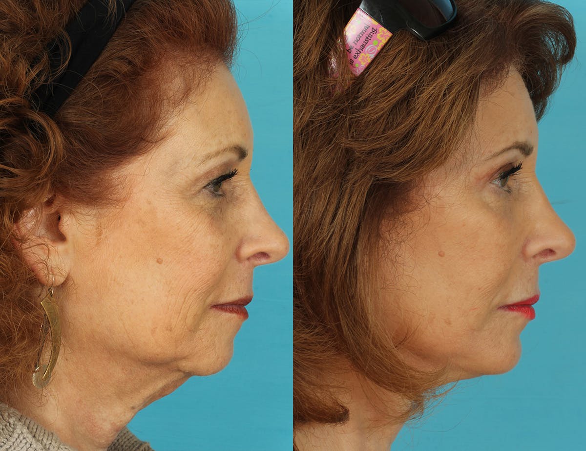 Before & Afters Before & After Gallery - Patient 406568 - Image 3