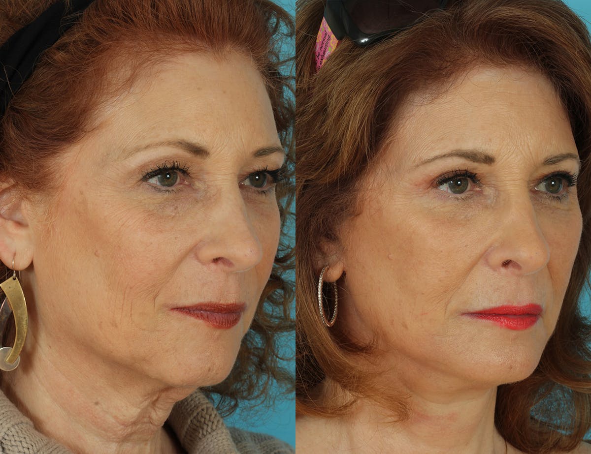 Before & Afters Before & After Gallery - Patient 406568 - Image 2