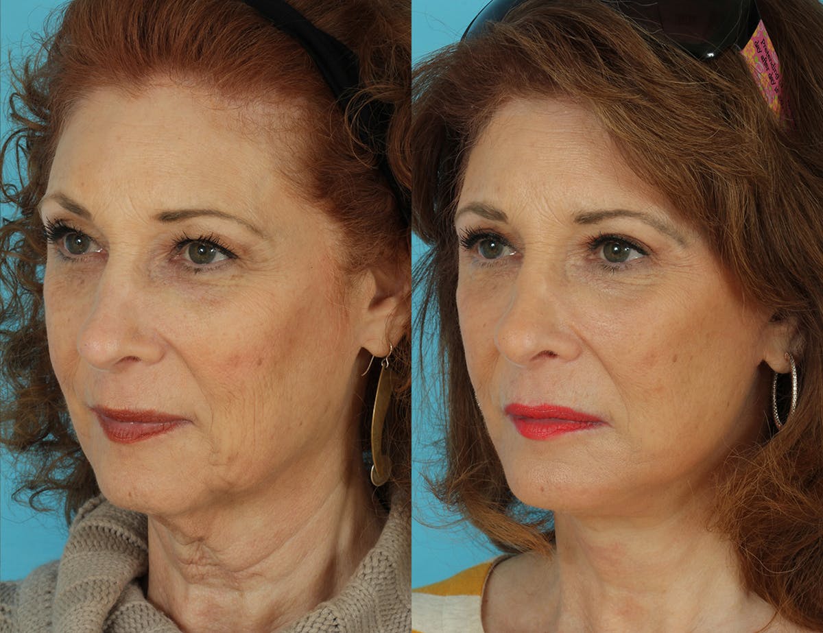 Before & Afters Before & After Gallery - Patient 406568 - Image 4