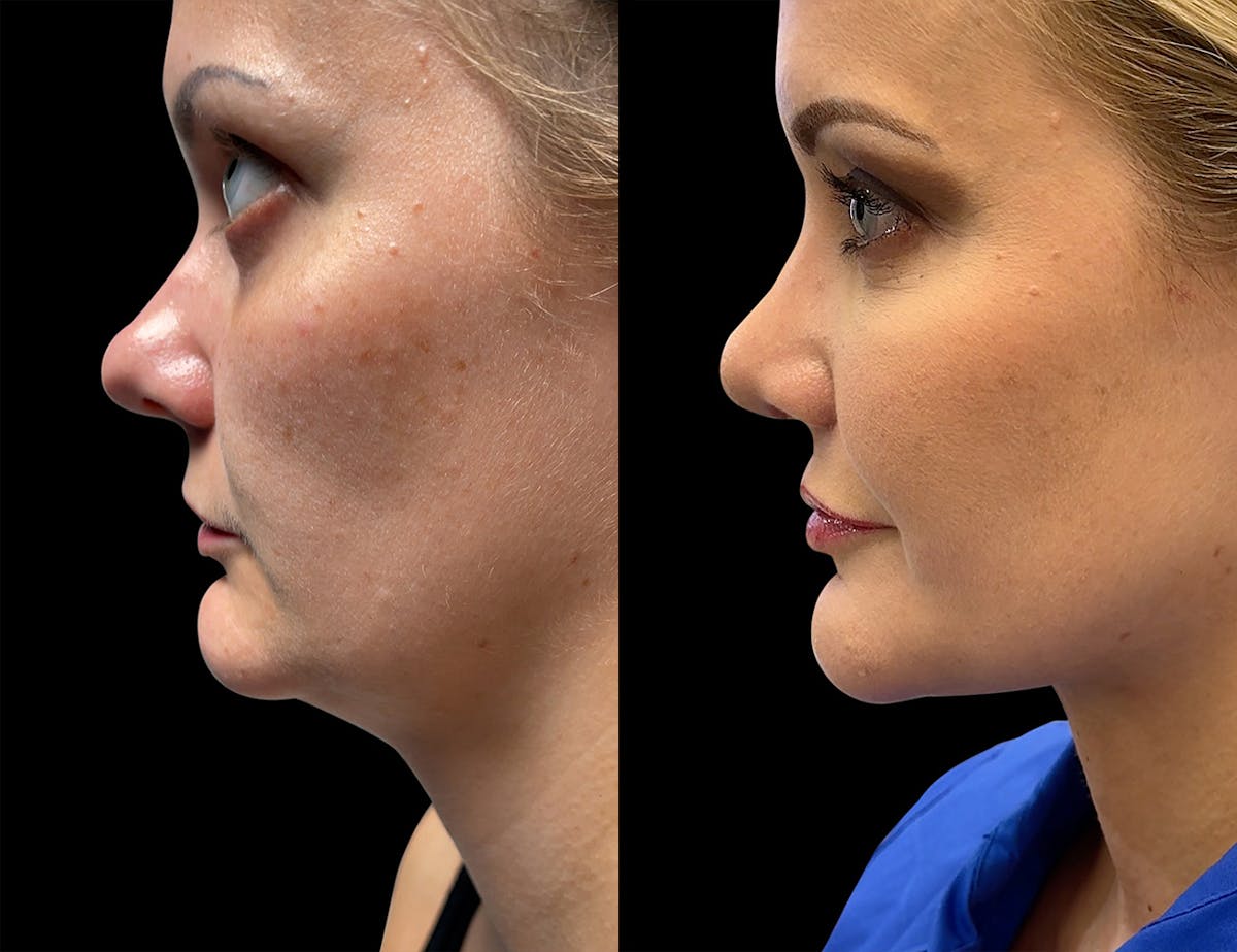 Before & Afters Before & After Gallery - Patient 127268 - Image 1