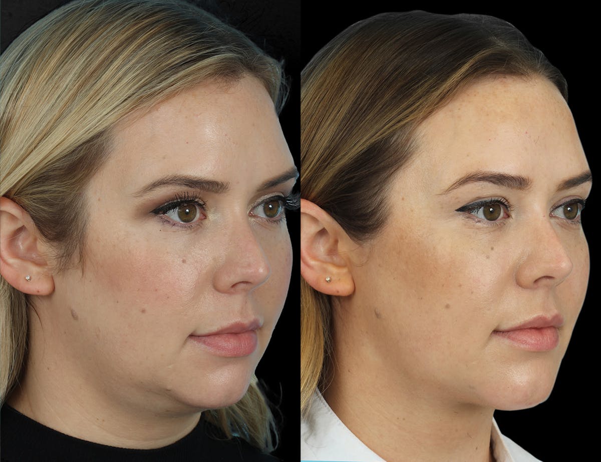 Before & Afters Before & After Gallery - Patient 196314 - Image 1