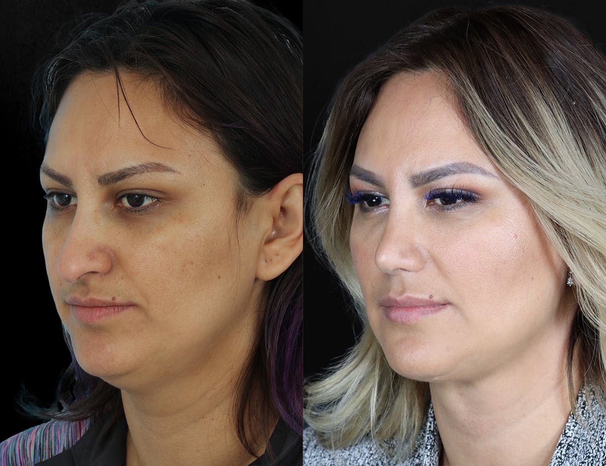 Before & Afters Before & After Gallery - Patient 140004 - Image 2